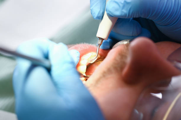 Best Knocked-Out Tooth (Avulsed Tooth) Treatment in Meadow Woods, FL
